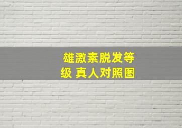 雄激素脱发等级 真人对照图